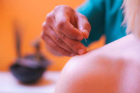 ¿Qué es la acupuntura? - foto 3